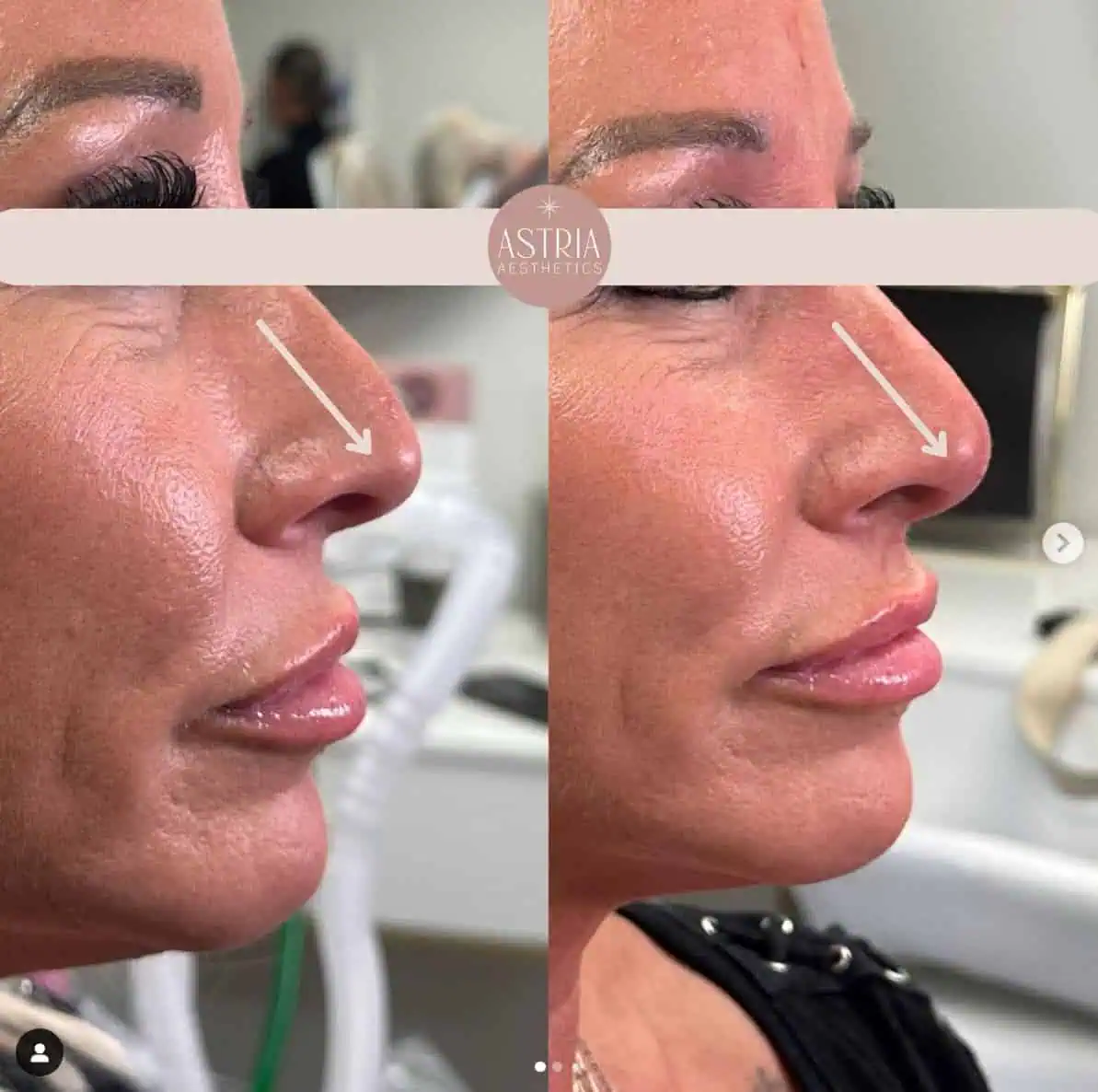 Nose threads-Results