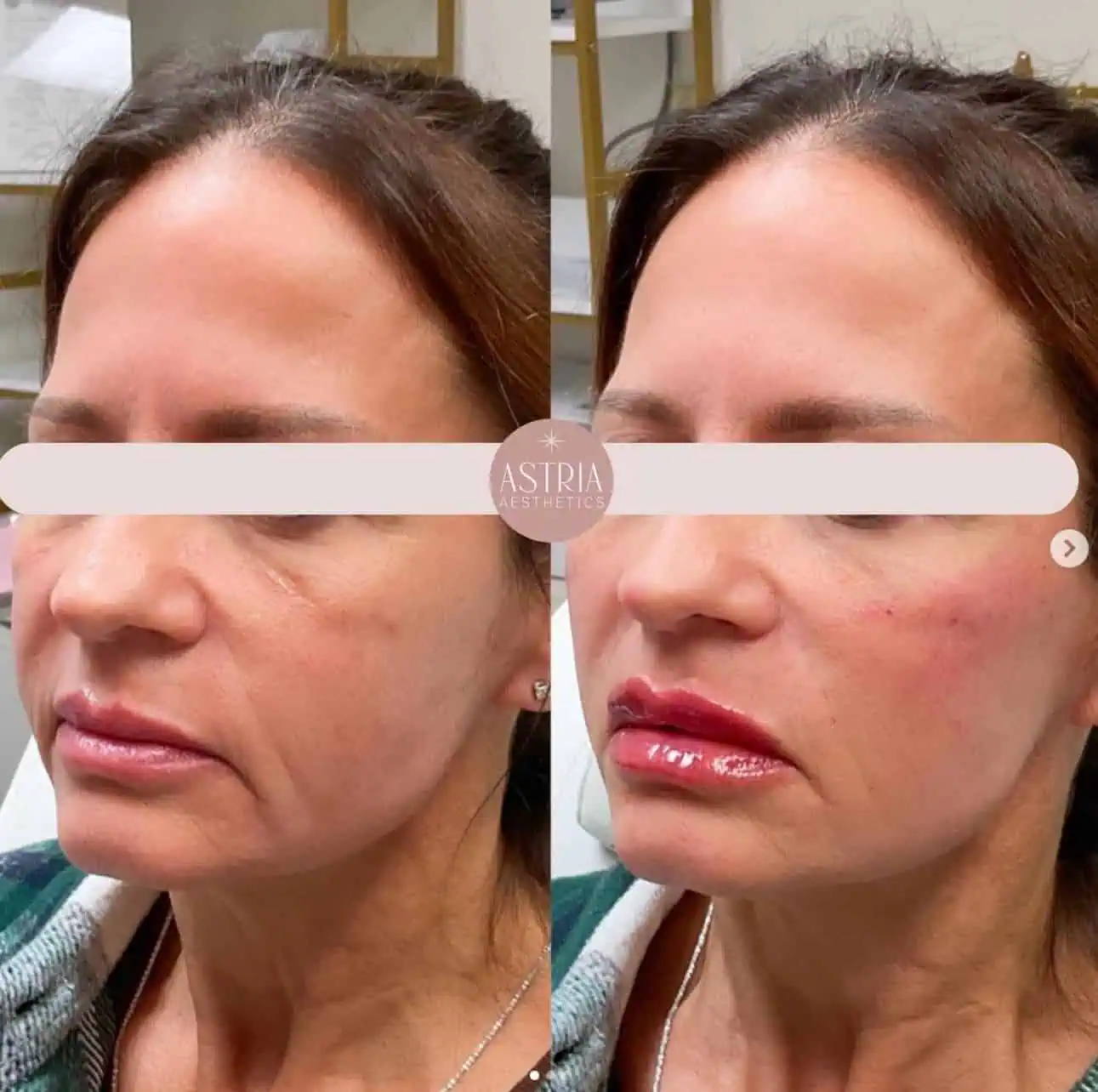cheek filler