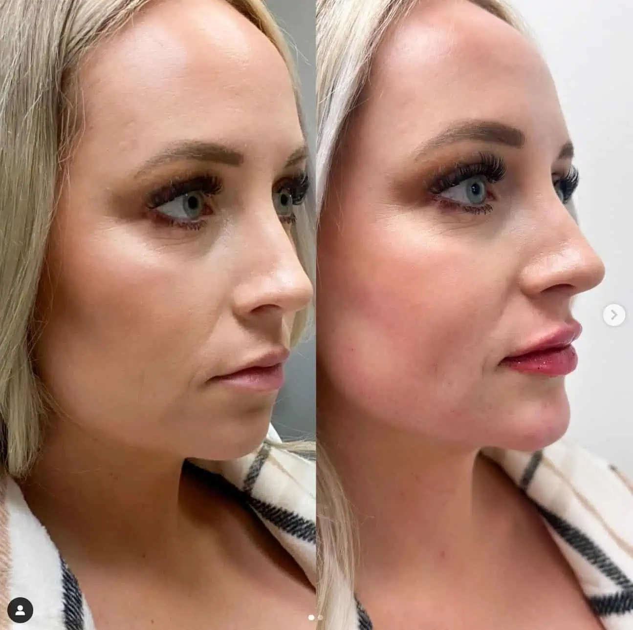 chin filler