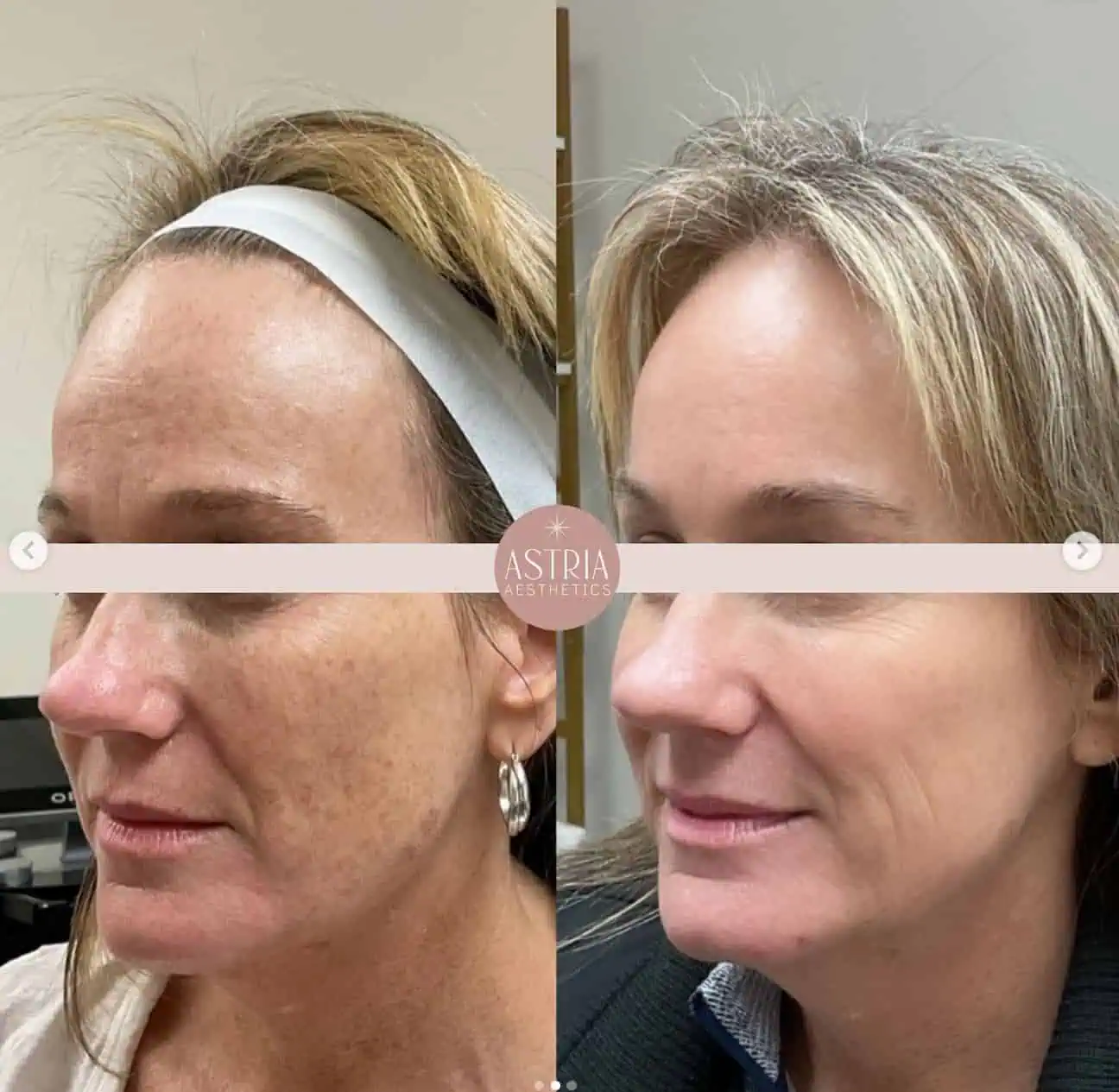 lumecca cool peel 2