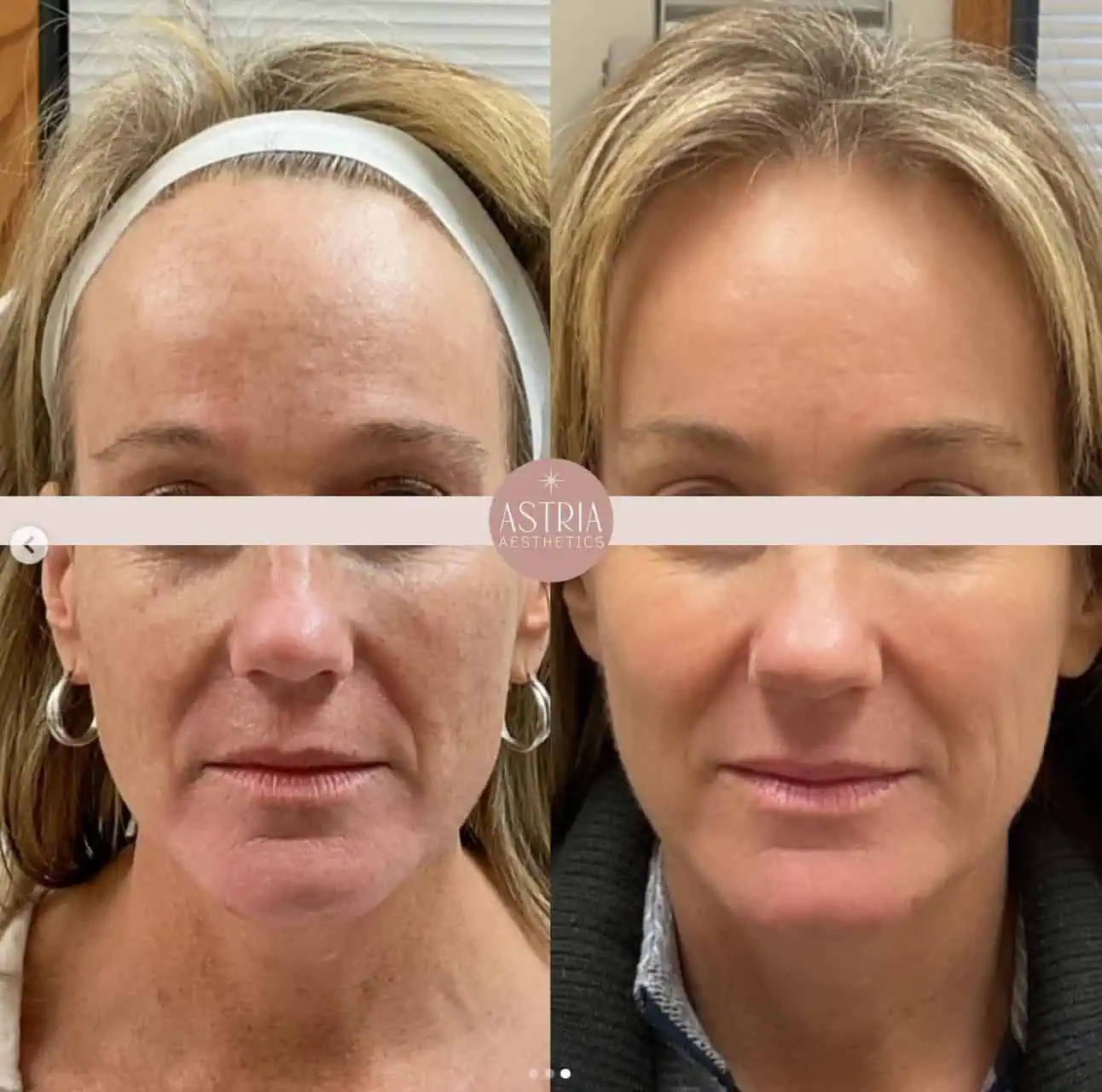 lumecca cool peel 3