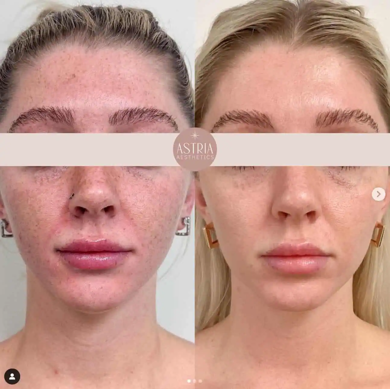 lumecca cool peel 4
