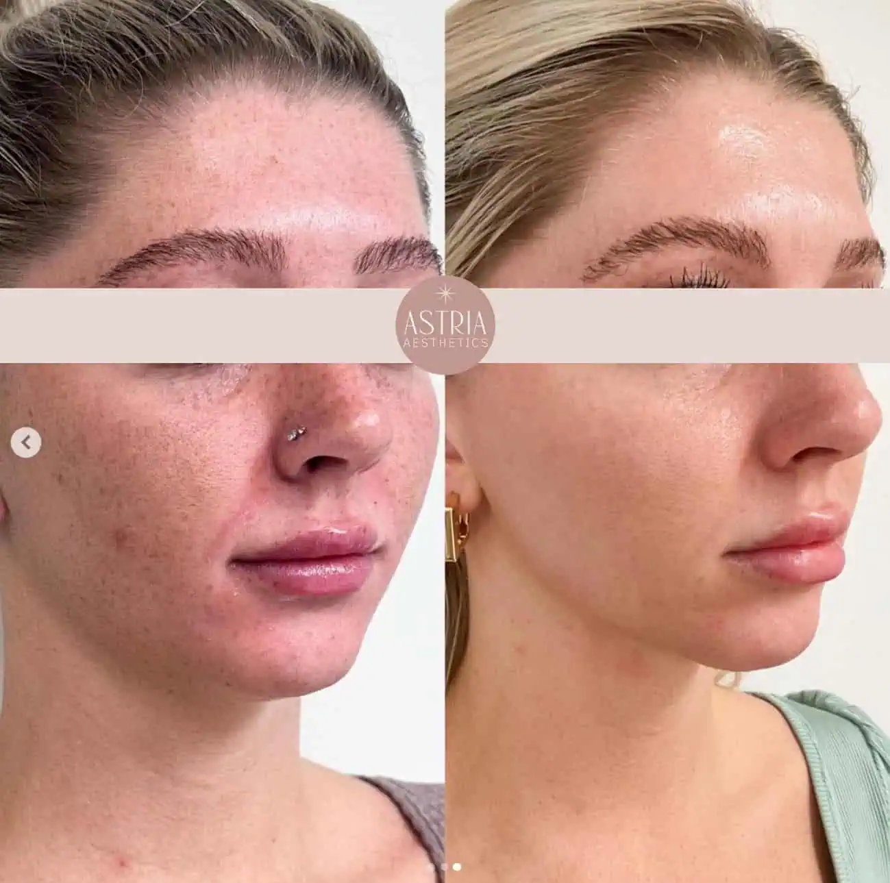 lumecca cool peel6