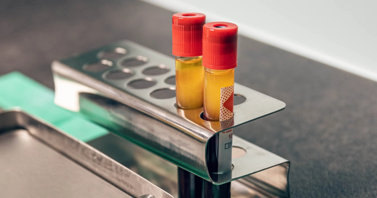 Two PRP test tubes in a metal rack, for PRF Injections in Grove City, Pickerington, and Columbus, OH.