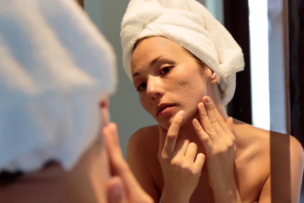 Woman examining acne scars and enlarged pores before microneedling treatment for smoother skin texture and even tone.